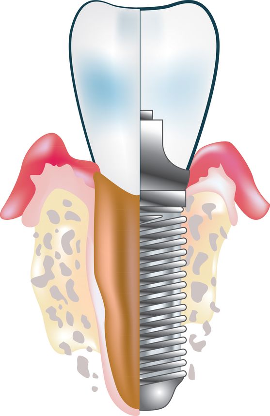 Illustration d’un implant dentaire